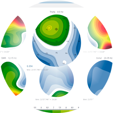 Wynik badania QEEG przedstawiający mapy topograficzne mocy fal mózgowych Theta, SMR i Beta.